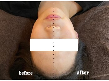 モモスパ(MOMOspa.)/頭蓋骨小顔矯正ビフォアフター