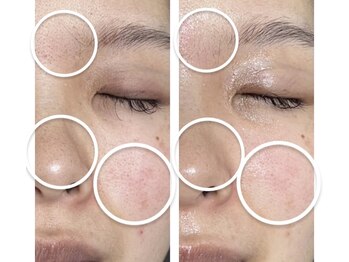 ナナマルニ 高知店(702)/毛穴の黒ずみ対策