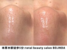 ベリンダ(BELINDA)/毛穴洗浄ハイドロスプラッシュ