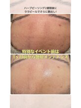 トリアングル(TLIENGLE)/ララピール　before　after