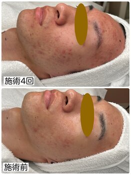 アロマ(AROMA)/メンズ脱毛/ヒゲ脱毛/４回後