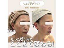 リリーオン 梅田店(RILLEE-ON)の雰囲気（他にはない完全オーダーメイド施術で、たるみ・肌質まで改善）