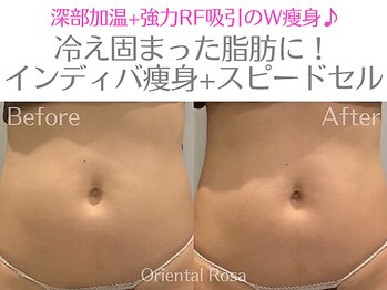 オリエンタルローザ 表参道(Oriental Rosa)/お腹インディバ痩身で理想Body♪