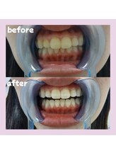 パレ 大阪十三店(Palet)/初回照射後のbefore/after