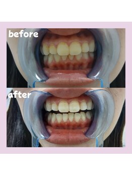 パレ 大阪十三店(Palet)/初回照射後のbefore/after