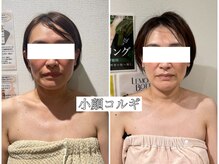 イデアルミー 大宮店(イデアルMe)/40代のお客様《小顔コルギ》