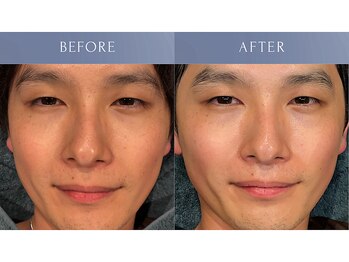 カズキハギワラ(Kazuki Hagiwara)/アンストレス施術当日ビフォアフ