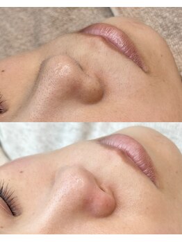 メメビューティー アンド ワキシング(meme beauty&waxing)の写真/【毛穴エクストラクションプロ】毛穴美人コース90分