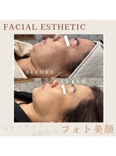 エアリアル 南行橋店/顔脱毛＆リフトアップ