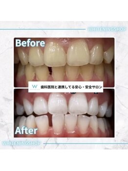ホワイトニングショップ 豊田店(WHITENING SHOP)/10回コース♪