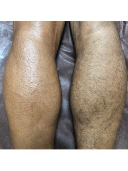 ハレノヒ(HaLeNoHi)/【ブラジリアンワックス】