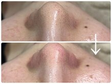 ニコ(Nico)/毛穴エクストラクション