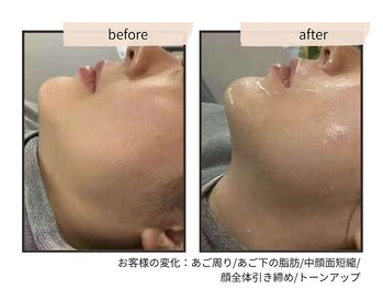 コンビンス(convince)/小顔【医療提携】脂肪分解剤導入