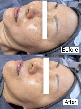 リル(Rire)/Before→After　50代