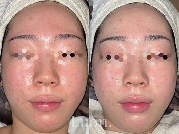 ルオン(Luon.)/乳酸菌ピーリング１回