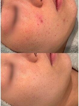 タリア(TALIA)/頑固な赤いニキビケアに◎