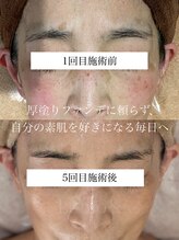 ルーモアンド(Lumo&)/シミケア