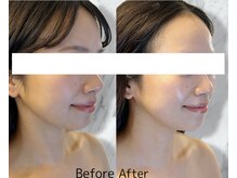 ルミライ(Lumirai)/たるみ改善|毛穴|フェイシャル