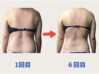 ネオボディ(Neo Body)/施術6回目