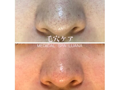 【医療提携】肌改善専門店Luanaハーブピーリング/毛穴/毛穴洗浄/ニキビケア/小顔/痩身の写真