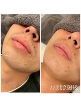 エクラ(eclat)/メンズひげ脱毛