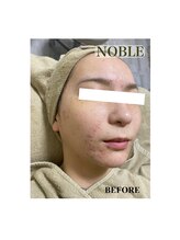 ノーブル 新宿南口(NOBLE)/新宿ハーブピーリングNOBLE