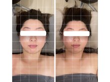 ジーニー(Genie)/これは小顔矯正？！