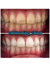 ホワイトニングショップ 盛岡店(WHITENINGSHOP)/コーヒーの着色も綺麗に♪