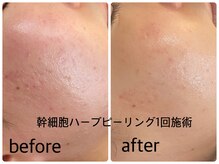 デューン 蕨店(Dune)/韓国で話題の幹細胞導入