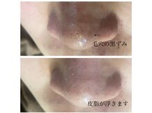 メンズプシュケ(men's PSYCHE)/毛穴洗浄