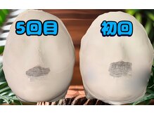 ベルエット 千葉店/初回と5回目の比較です☆