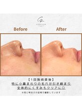 サレンダー(SURRENDER)/ハーブクリームピーリング施術例