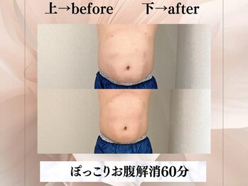 イヨヨ(iyoyo)/【痩身】Before After