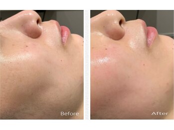 ブライズ(BRISE)/ピーリング