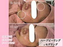 エン クリニカルラボ 心斎橋店(E&N CLINICAL LABO)/ハーブ×モデリングパック