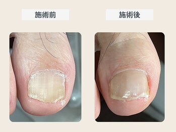 ルポ 伊勢/巻き爪ケア