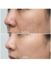 多穏スキンケア(skin care)/人気No.2サーマルフラクショナル