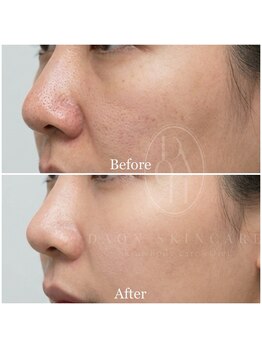 多穏スキンケア(skin care)/人気No.2サーマルフラクショナル