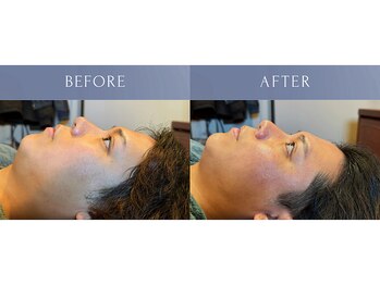 カズキハギワラ(Kazuki Hagiwara)/ビオフィート施術当日ビフォアフ