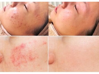 ナチュレアンドメディカ(Nature&Medica)/ニキビ集中ケア(Wフェイシャル)