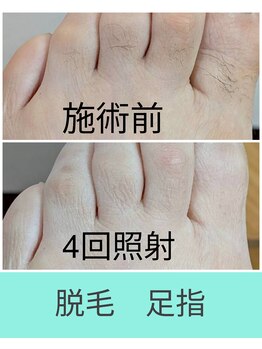 エミナル(EMINAL)/足指脱毛の効果! 脱毛/毛穴