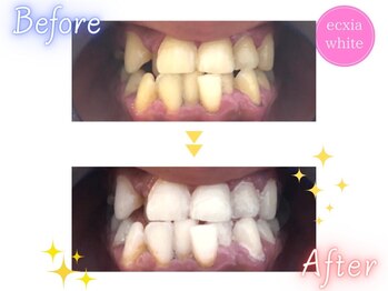 セルフホワイトニングサロン　エクシアホワイトニング宇治小倉店/ビフォーアフター