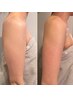 【韓国で話題!!究極の部分ケア】リポベラ6ml★二の腕ぷよ肉集中撃退