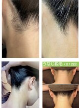 キックアス(KICK ASS)/うなじ脱毛 うなじ美人