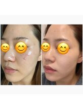 モイ(moi.)/◆マイクロニードルピーリング◆