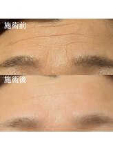 ルマ(Rumah)/額のシワ改善にも効果あり