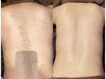 ジュエリーボディー(Jewelry body)/ブライダルを控えている方!