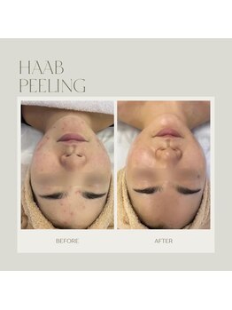 ルアナ(LUANA。)/ハーブピーリング#肌質改善#三郷