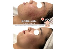 サラ 恵比寿店(SARA)/２フォトRF ニキビケア