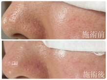 カピリナ(ka pilina)/ビフォーアフターで一目瞭然!！